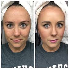 Black And White Bleaching Cream Before And After Pin On Lime Life