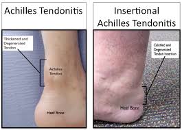 Achilles tendinitis, or tendonitis, usually results from microtears that occur in the tendon during strenuous, high impact exercise, such as running. Pin On Pt