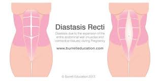 diastasis recti the real reason you