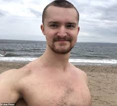 Man says withdrawal from steroid eczema creams caused a horrific skin  condition