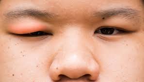 Sejak 4 5 hari ni kelopak mata sebelah kiri saya berdenyut denyut jugak sebelum ni xpenah terjadi. 12 Penyebab Mata Bengkak Bukan Cuma Kurang Tidur Dan Menangis Cantik Tempo Co