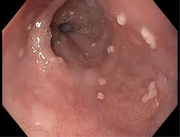 Mucosa is erythematous, edematous, ulcerated or friable (cottage cheese esophagus). Infectious Esophageal Disorders Gastrointestinal Disorders Msd Manual Professional Edition