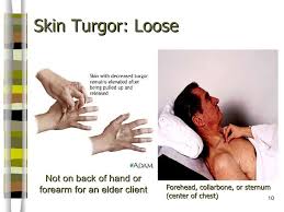 Skin Turgor Scale Google Search Loose Skin Back Of Hand