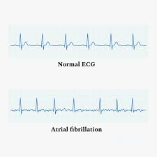 Image result for Atrial Fibrillation