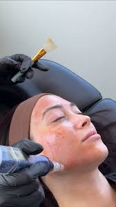 The bts of glass skin 🪞 , Microneedling induces collagen production by  creating micro “injuries” in the skin. Each micro “injury” creates a  channel that triggers the body to produce new collagen and ...