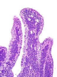 Lymphoma in cats is a type of cancer that affects the blood. Differentiating Feline Intestinal Lymphoma From Inflammatory Bowel Disease Ibd College Of Veterinary Medicine At Msu