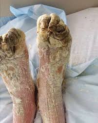 Image result for scabies norvegica