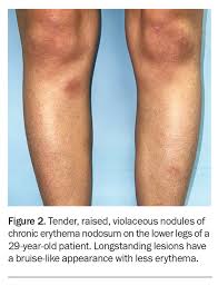 Image result for erythema nodosum