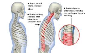 Sumsum tulang belakang ini juga dibungkus oleh selaput meninges. Lebih Sakit Jika Tak Bergerak