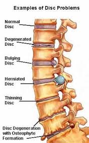 We would like to show you a description here but the site won't allow us. Lumbar Spondylosis Physiopedia