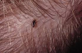 Pin On Lice Remedies