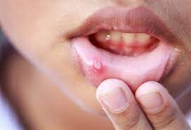Thrush is most common among those debilitated by disease, denture wearers, newborns, and people with immune disorders. What Are Causes Of Blisters In The Mouth