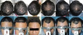 This helps to get them to grow new hair. Efficacy And Safety Of Oral Minoxidil 5 Mg Once Daily In The Treatment Of Male Patients With Androgenetic Alopecia An Open Label And Global Photographic Assessment Springerlink