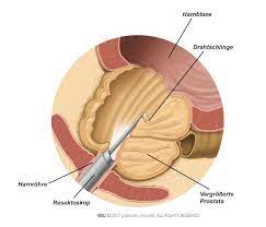 Transurethrale Resektion Der Prostata Turp Pi De