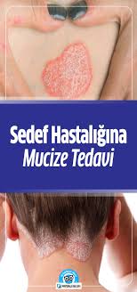 Sedef Hastaligina Mucize Tedavi Faydali Bilgin Dogal Saglik Saglik Saglik Urunleri