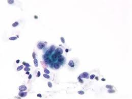 Including mm and other types of cancer, in cytologic specimens and pleural biopsies. Bronchial Cytology In Pleural Mesothelioma Semantic Scholar