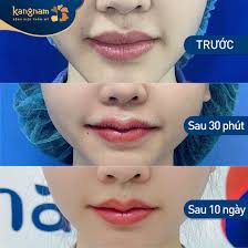 Cắt môi trái tim bao lâu thì đẹp? Cách chăm sóc sau phẫu thuật