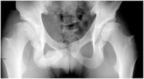 Image result for what hip dysplasia causes symptoms and treatment