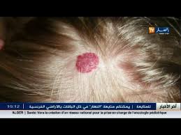 3 دقائق صحة الأكياس الدهنية فوق الرأس مسبباته وطريقة علاجه Youtube