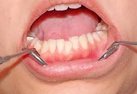 Get a long piece of dental floss (roughly 18cm), so that the ends can be wrapped. Do You Need Braces 7 Potential Reasons Malocclusions You May