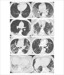 En caso de acudir a una clínica, debes ingresar al servicio de urgencia y en el caso de un centro médico, al laboratorio. Cuadro Clinico Del Covid 19 Sciencedirect