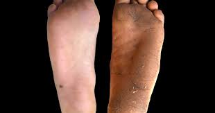 Hard hud på føttene er en naturlig følge av et aktivt liv. Hard Hud Er Bedre Enn Sko