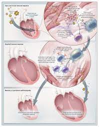 There is no 'covid heart'.. Myocarditis Nejm