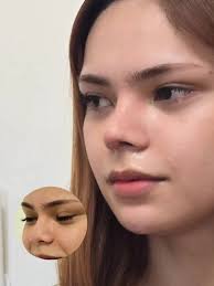 6 weeks post surgery #ilizarov #philippineorthopedic #tibiafibula