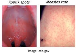 Image result for measles