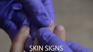 Image result for Capillary Refill