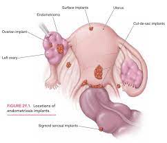 Bloating is also associated with the condition, and while it causes. Endometriosis Pathology