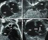 Image result for rashkind balloon atrial septostomy