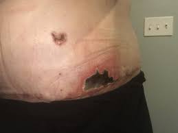 There are many sequelae to ocular necrosis (e.g. Will My Necrosis Heal On Its Own Photos