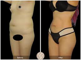 Image result for Liposuction