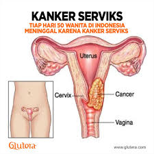 Pada kanker serviks gambaran nyeri seara klasik disebabkan oleh massa yang ada didalam didalam pelvis pelvis dan limphadenophati. Tiap Hari 50 Wanita Meninggal Karena Kanker Serviks Yuk Kenali Gejalanya Times Indonesia