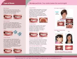 I'm no longer a #braceface! Types Of Braces Whitesmile Orthodontic Dental Braces Specialist Kuala Lumpur