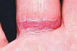 Wedding Ring Dermatitis Which I Have Allergy To Nickel In White Gold Home Remedy Coat With Clear Nail Pol Wedding Ring Allergy Vitamins For Skin Dermatitis