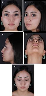 The Process of Single Surgeon Through Structural and Dorsal Preservation in  Primary Rhinoplasty: A 594 Case Series with One-Year Follow-Up