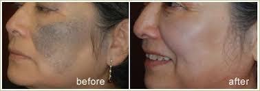 Birth Mark Removal in Kolkata