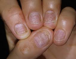 Psoriasis is a chronic inflammatory skin condition that is often associated with systemic plaque psoriasis is the most common form. Psoriazisul Unghiilor Ce Este Simptome Si Tratament Bio Sculpture Romania