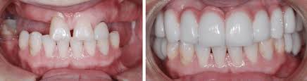 Maybe you would like to learn more about one of these? Dental Implants Faq Vancouver Centre For Cosmetic And Implant Dentistry