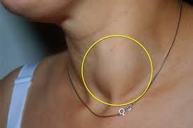 Maybe you would like to learn more about one of these? Cancer Visual Guide To Thyroid Cancer