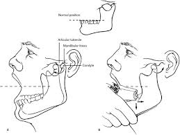 Image result for Jaw Dislocation