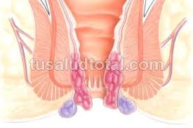 La trombosis hemorroidal se desarrolla en personas que ya tienen hemorroides y se caracteriza por la formación de coágulos en la región afectada. Que Son Hemorroides Trombosadas Causas Y Tratamiento