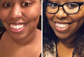 This Company Is Trying To Disrupt The Braces Industry And Dentists Are  Fighting Back