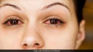 Image result for Allergic Conjunctivitis