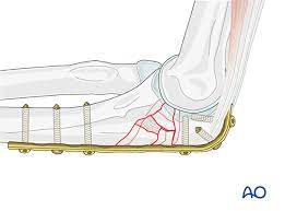 12 фраз в 2 тематиках. Ulna Articular Olecranon Multifragmentary Bridge Plate