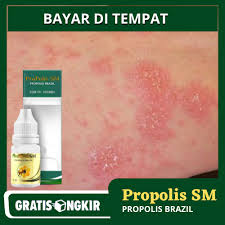 Selepas beberapa hari kemudian, kegatalan hilang dan bekas luka mengalir seperti mengubah kulit. Obat Kulit Gatal Bentol Merah Bersisik Bintik Bintik Kering Dan Menghitam Shopee Indonesia