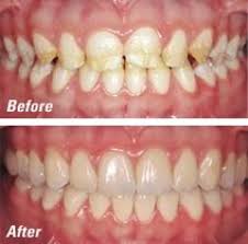 Carson City Dentists At Advanced Dentistry By Design Can Design Fabricate And Place Dental Restorations In A Sin Restorative Dentistry Dental Crowns Dentistry