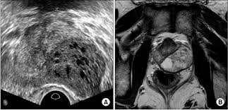 Discoveryhealth.com writers reading prostate cancer information about prostate cancer sym. A Transrectal Ultrasound Of The Prostate Showing A 35 Mm Download Scientific Diagram